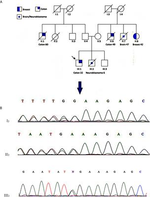 WRN Germline Mutation Is the Likely Inherited Etiology of Various Cancer Types in One Iranian Family